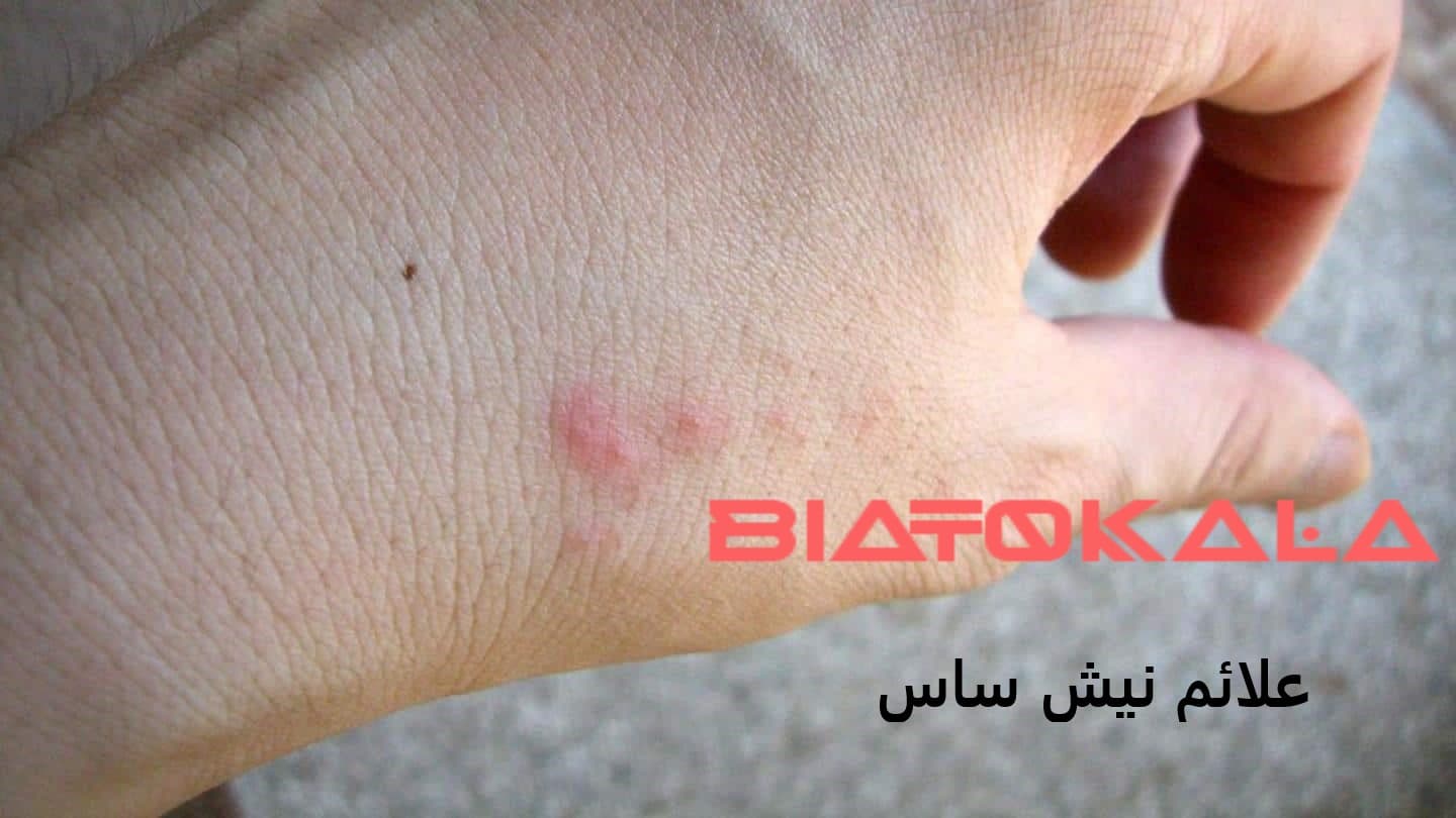 جای نیش ساس